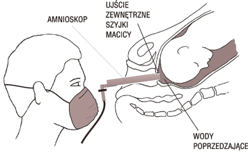 Ryc.4-5 Badanie amnioskopowe 