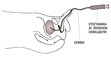 Cewnikowanie pecherza moczowego podczas cystoureterografii mikcyjnej