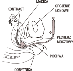 Jeden ze sposobów podania kontrastu
w histerosalpingografii