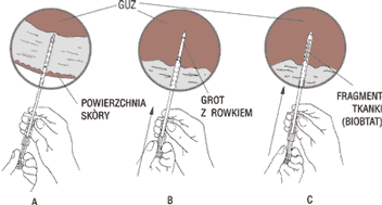 Poszczególne etapy wykonywania biopsji gruboigłowej (oligobiopsji)