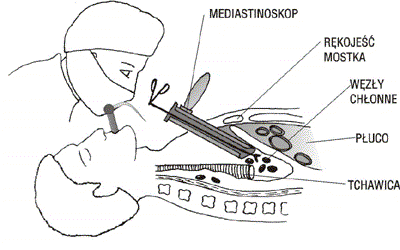 Schemat wziernikowania śródpiersia przy pomocy mediastinoskopu 