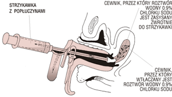 Techniki uzyskiwania materiału cytologicznego - pobranie aspiratu z jamy macicy