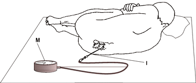 Ułożenia pacjenta w trakcie nakłucia lędźwiowego