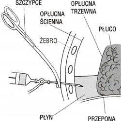 Punkcja opłucnej (przekrój przez ścianę klatki piersiowej)