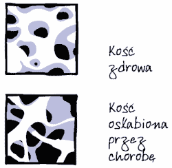 Porównanie struktury kości zdrowej i osłabionej przez osteoporozę