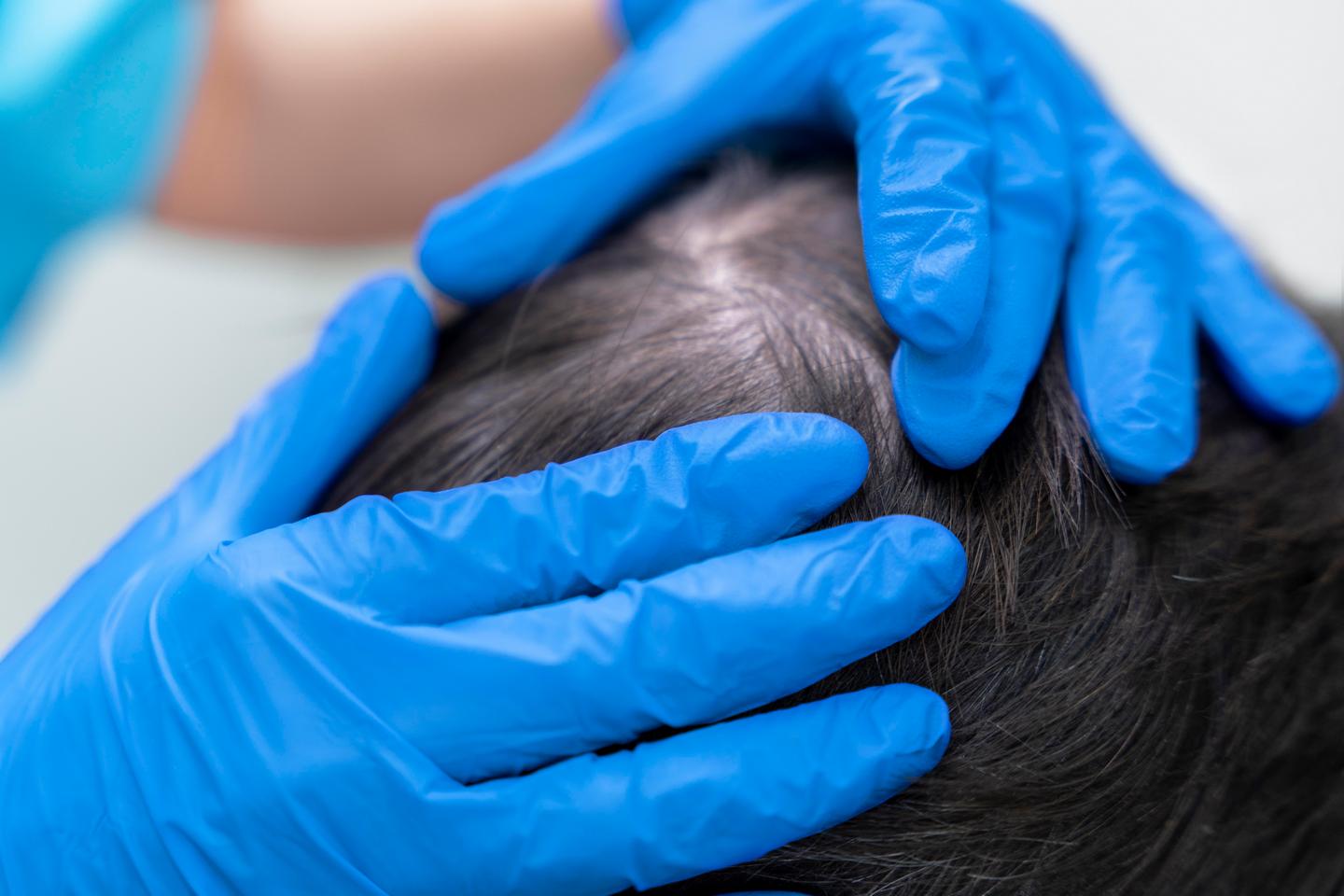 pacjent na wizycie u trychologa