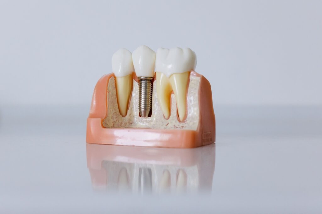 Model stomatologiczny przedstawiający implant zębowy w szczęce