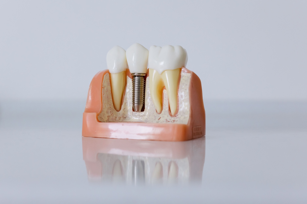 Model stomatologiczny przedstawiający implant zębowy w szczęce